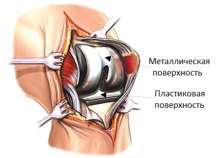 ендопротезування колінного суглоба фото