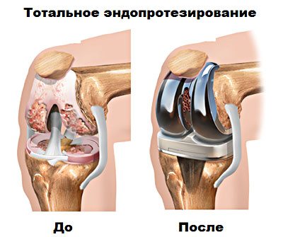 Операція ендопротезування колінного суглоба.